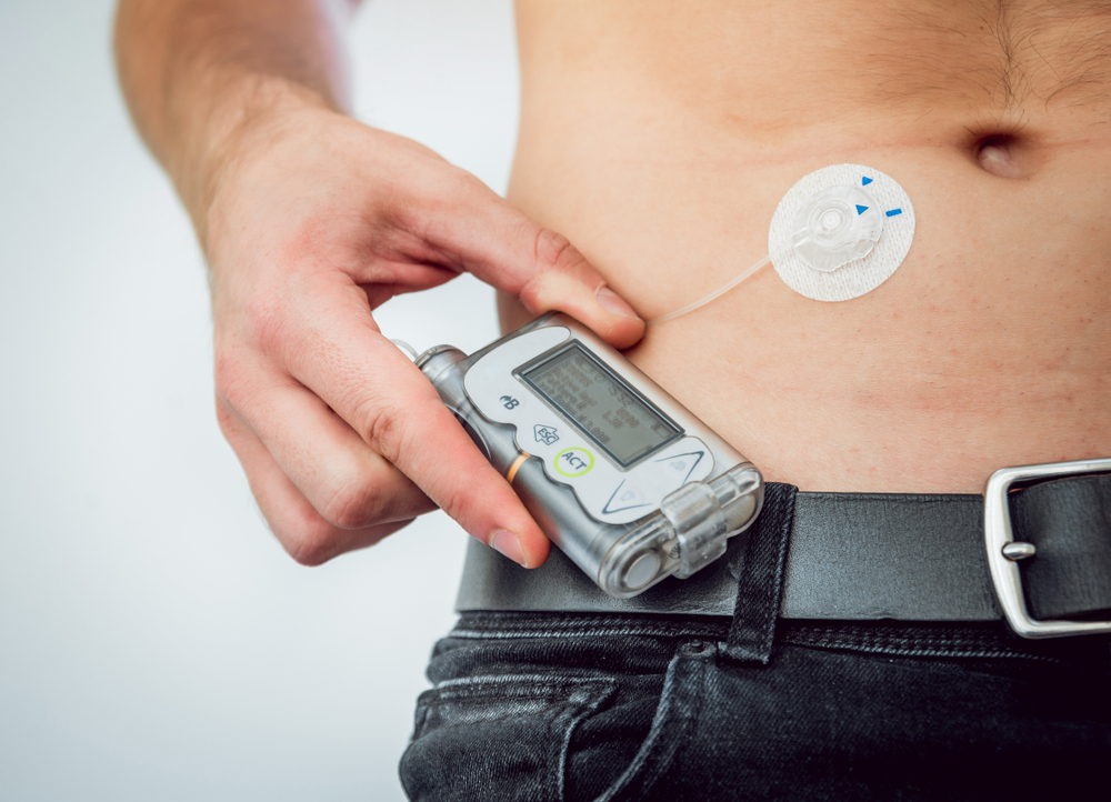 An introduction to insulin pump therapy